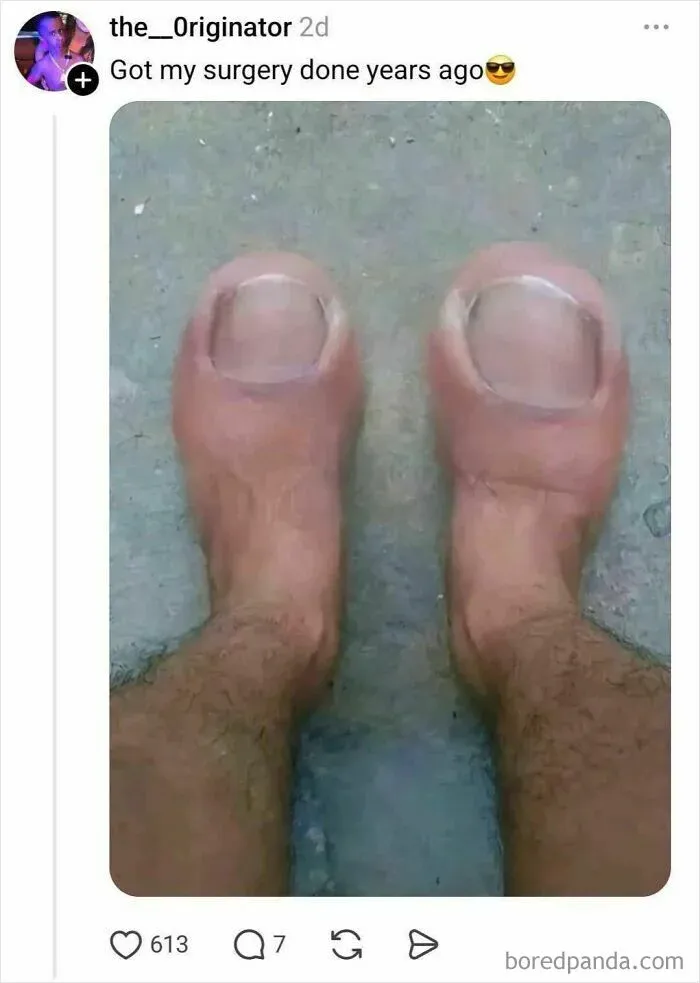 Funny surgery meme showing toenails replaced by large covers