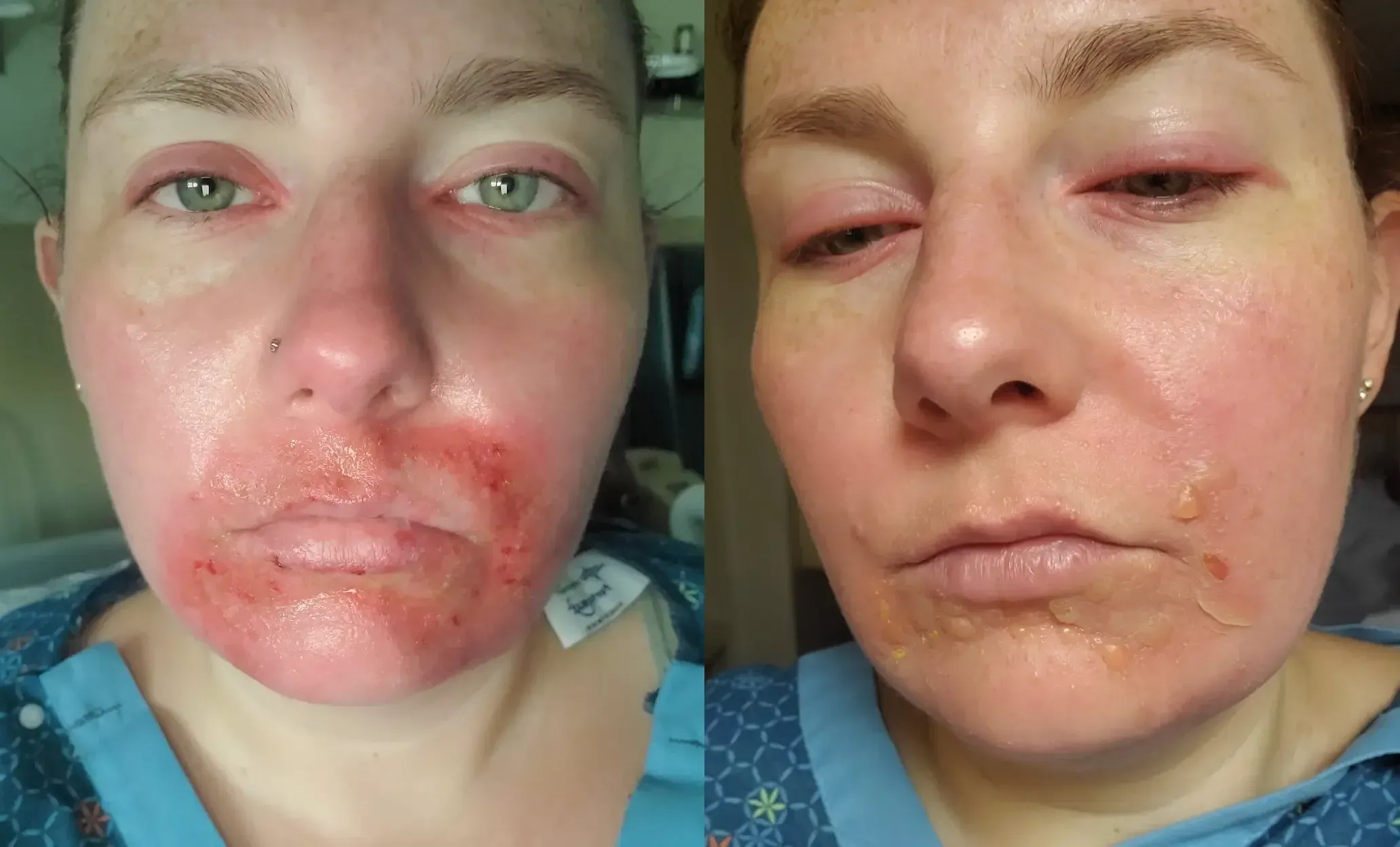 Brief sun exposure can send Emily to the hospital immediately.