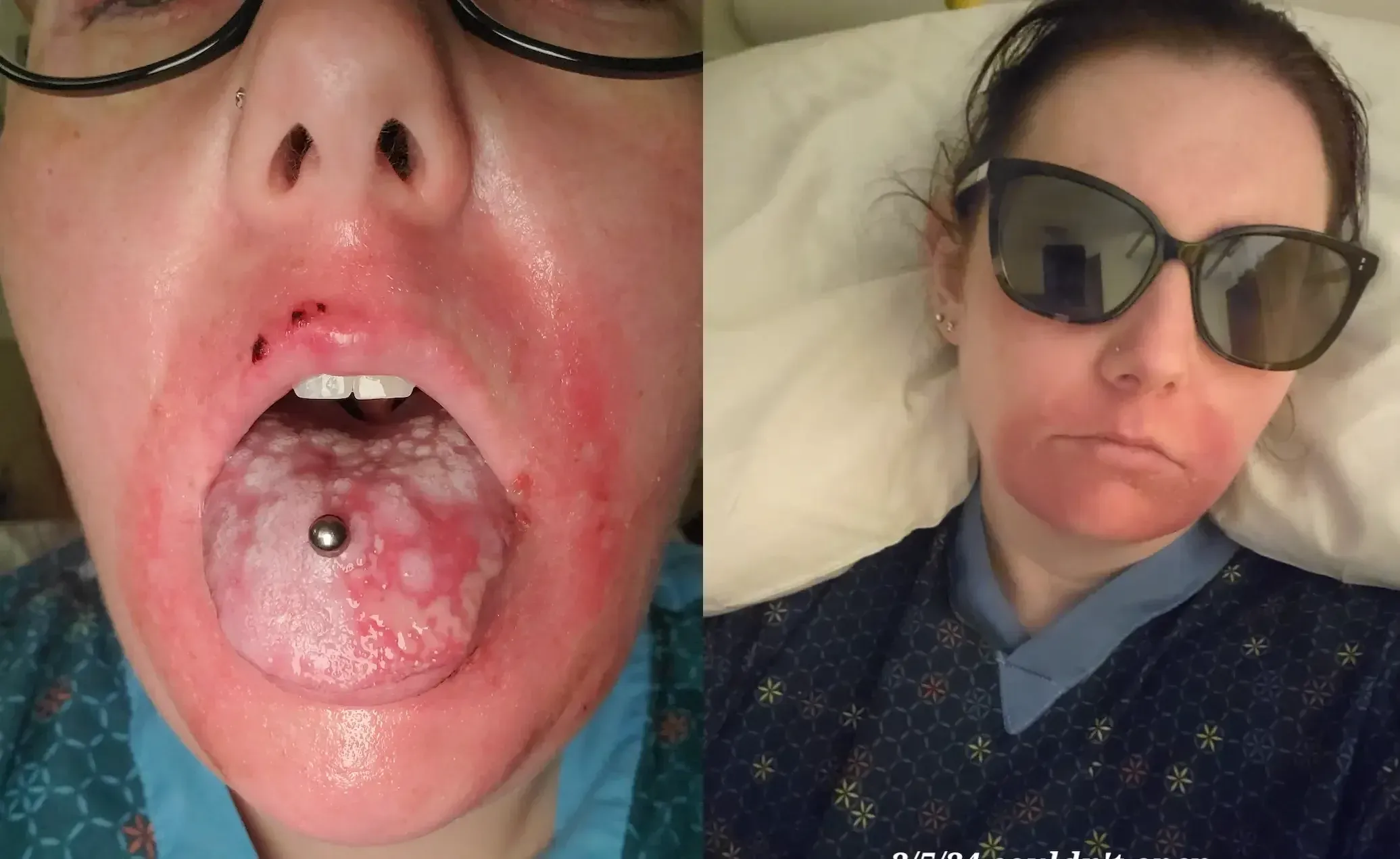 Emily has been hospitalized four times due to severe SJS reactions.